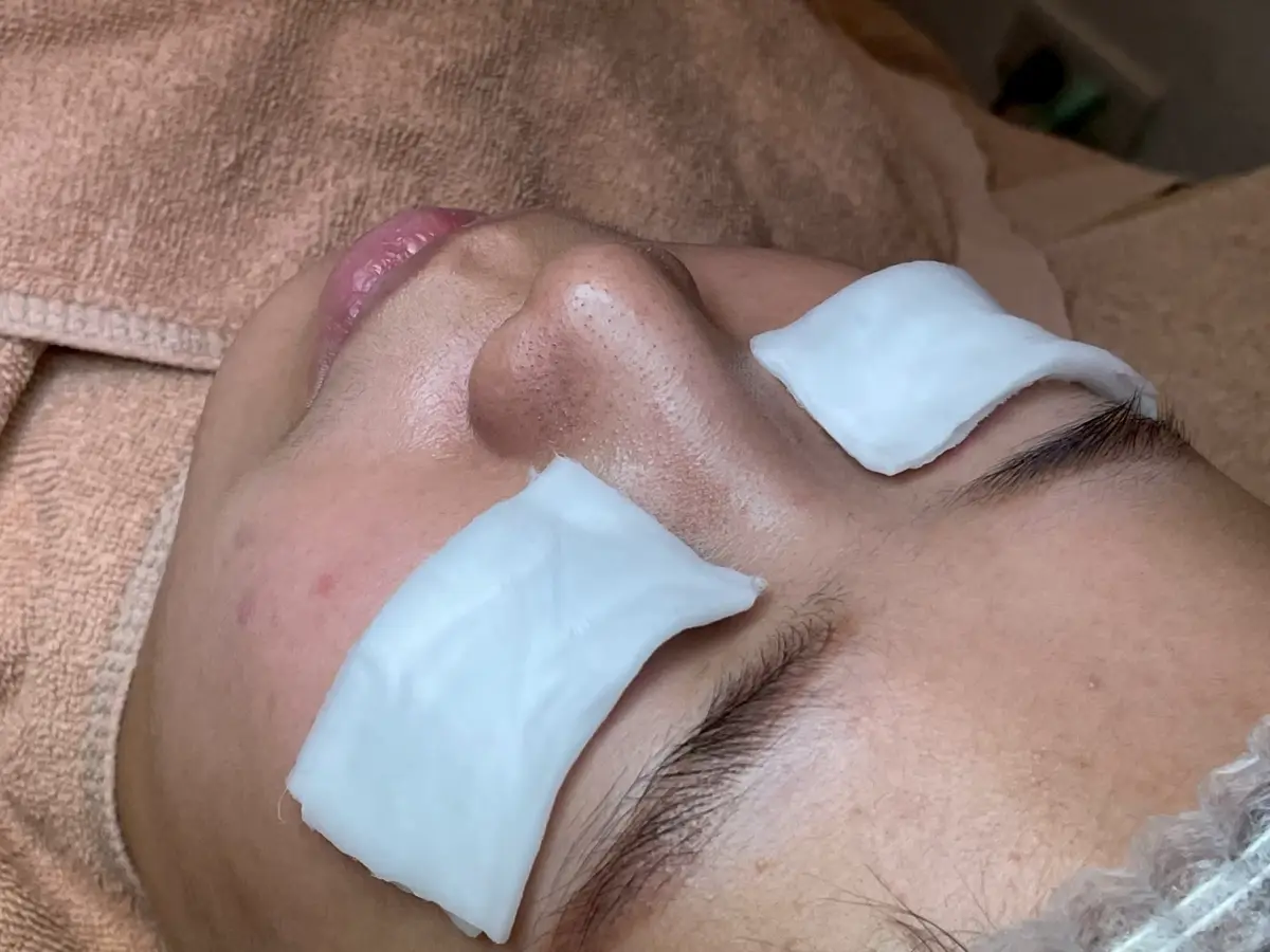 台南FILF小資美顏館 清粉刺杏仁酸做臉