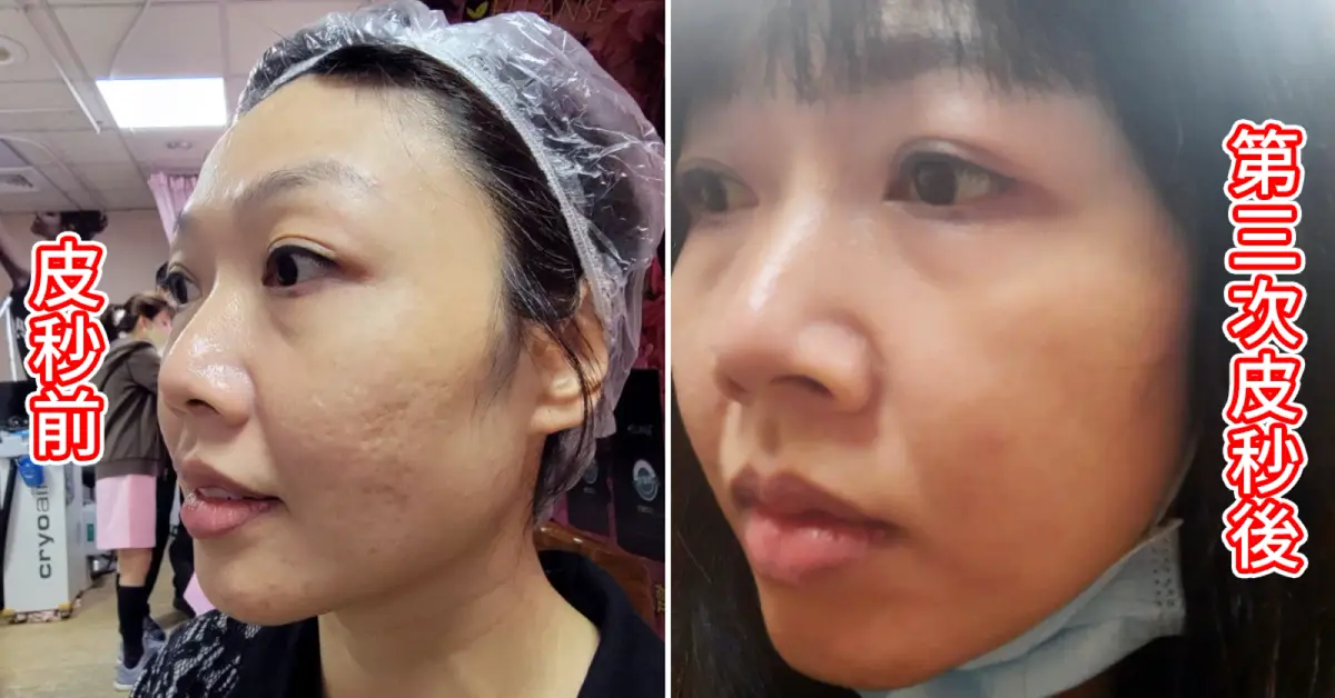 嘉義郭健軍皮膚科 皮秒雷射