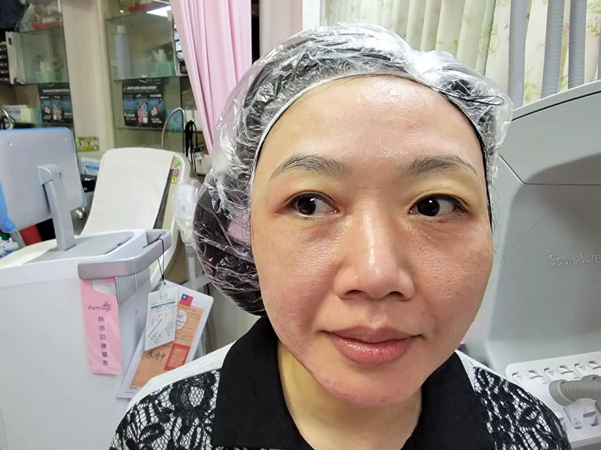 第一次皮秒雷射紀錄｜郭健軍皮膚科診所