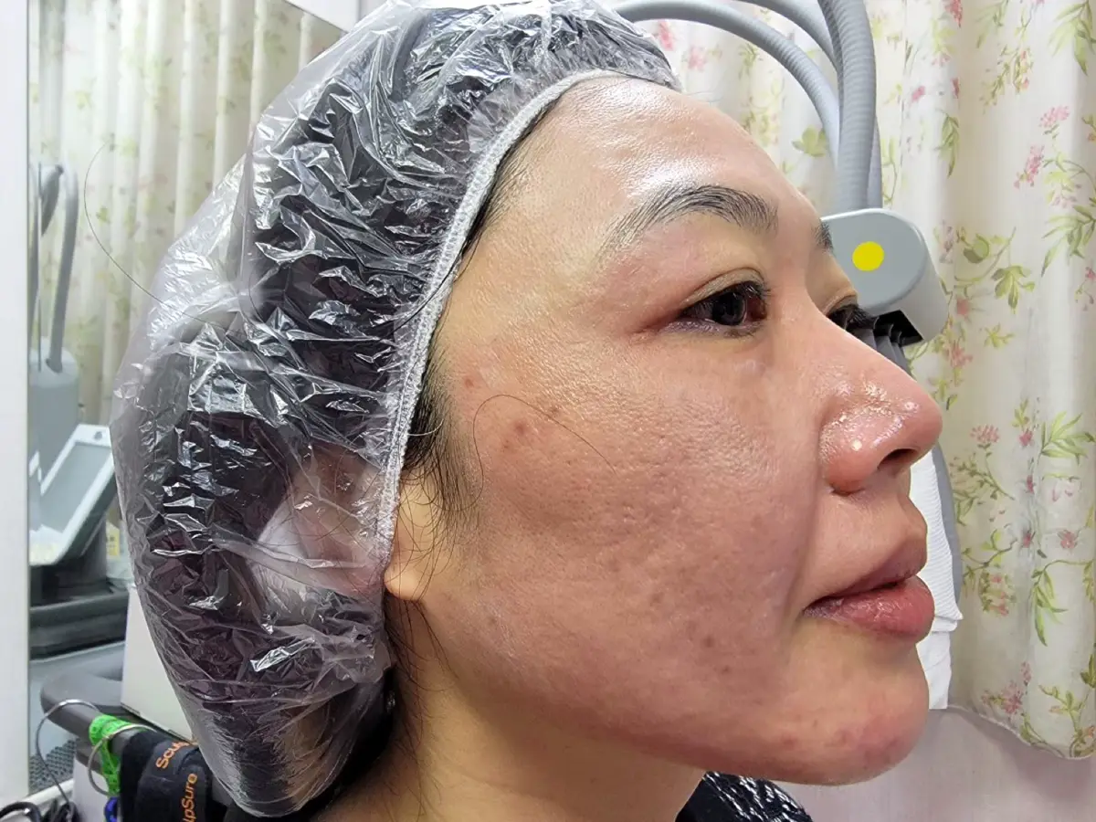 第一次皮秒雷射紀錄｜郭健軍皮膚科診所