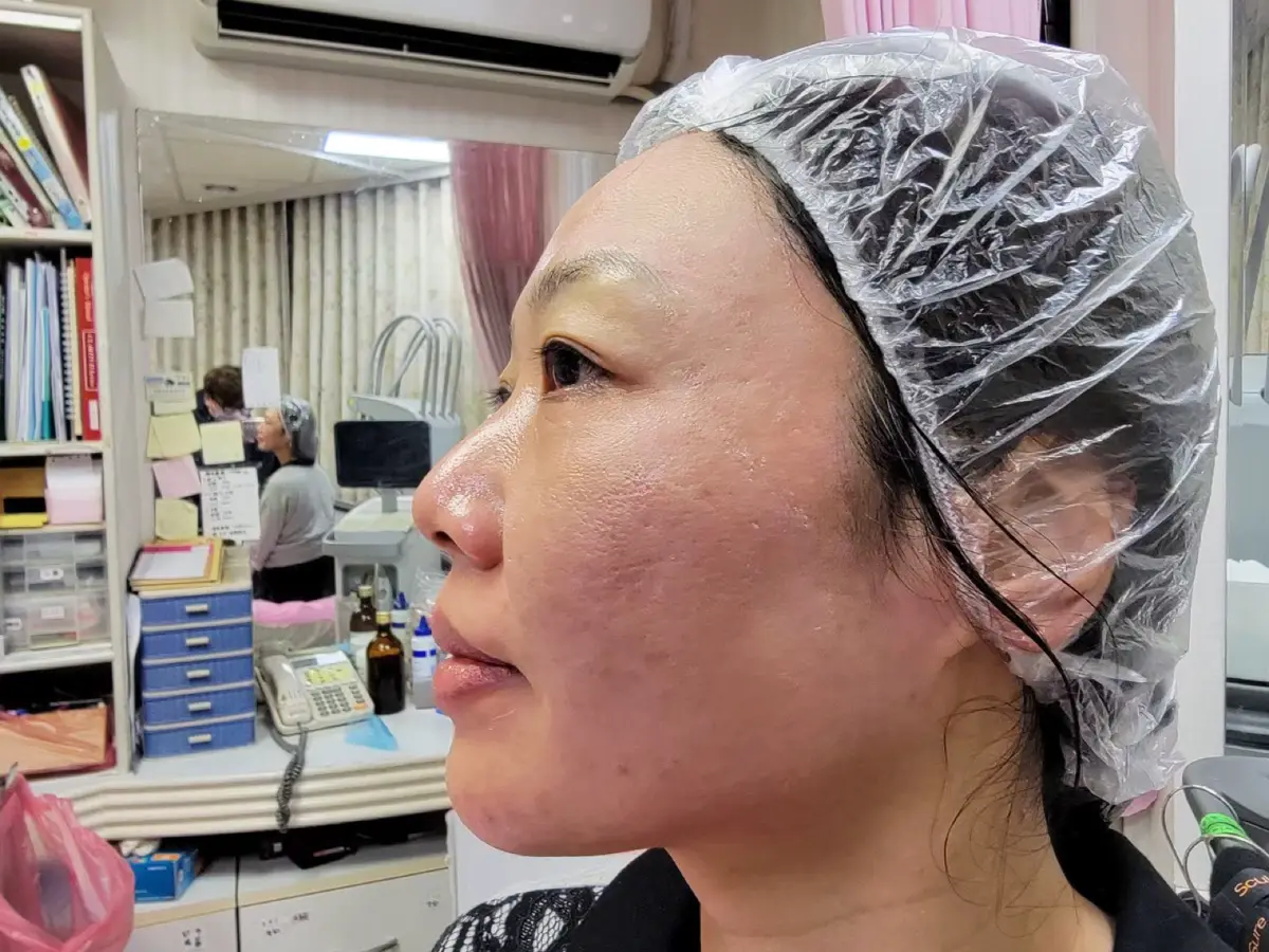 第一次皮秒雷射紀錄｜郭健軍皮膚科診所