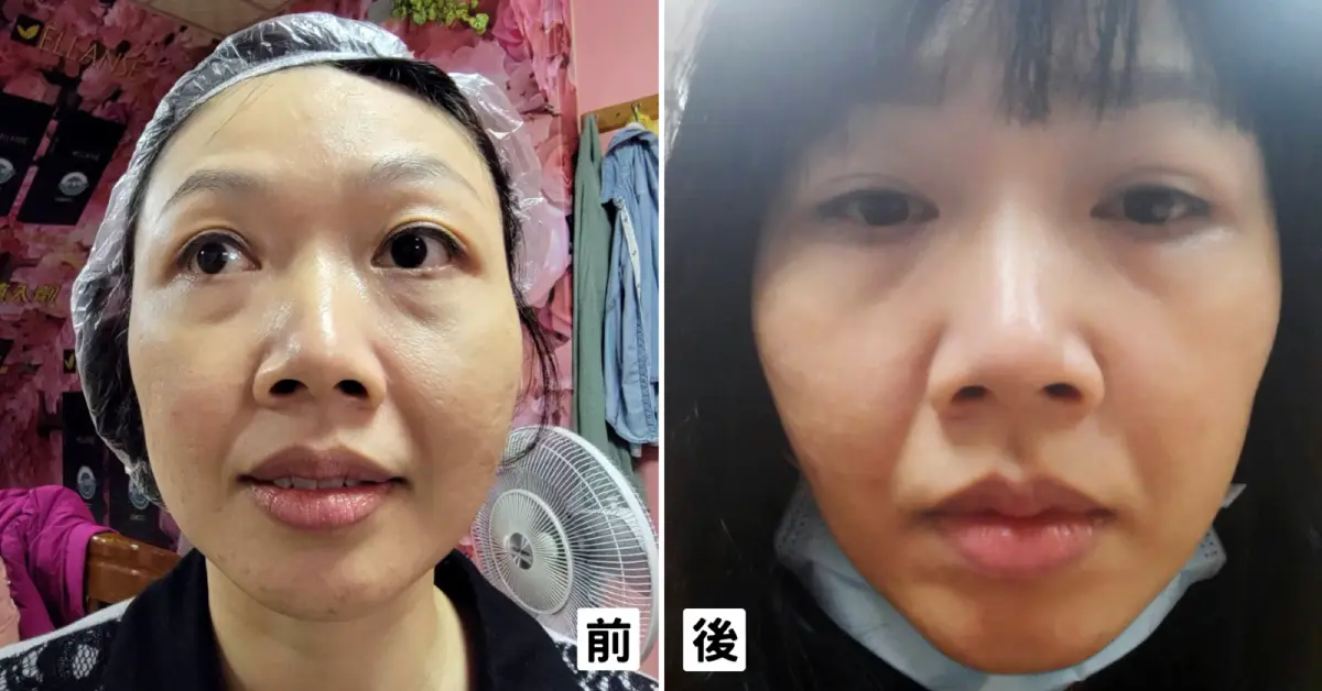 第一次皮秒雷射紀錄｜郭健軍皮膚科診所