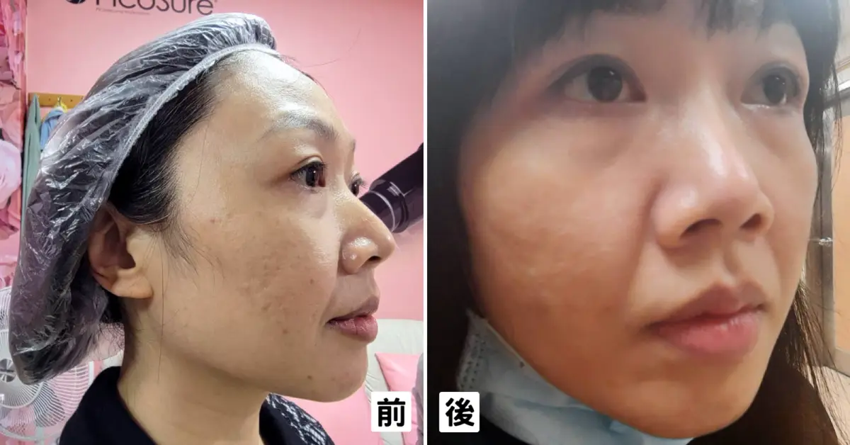 第一次皮秒雷射紀錄｜郭健軍皮膚科診所