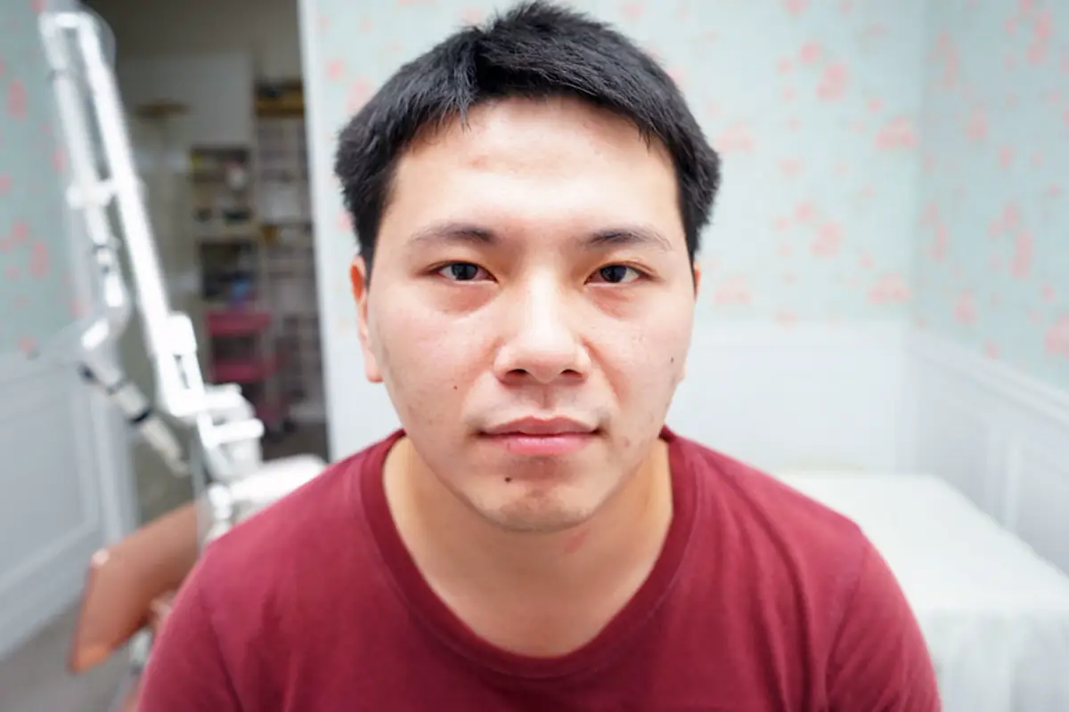 嘉義劉怡慧皮膚科診所 雷射痘疤治療