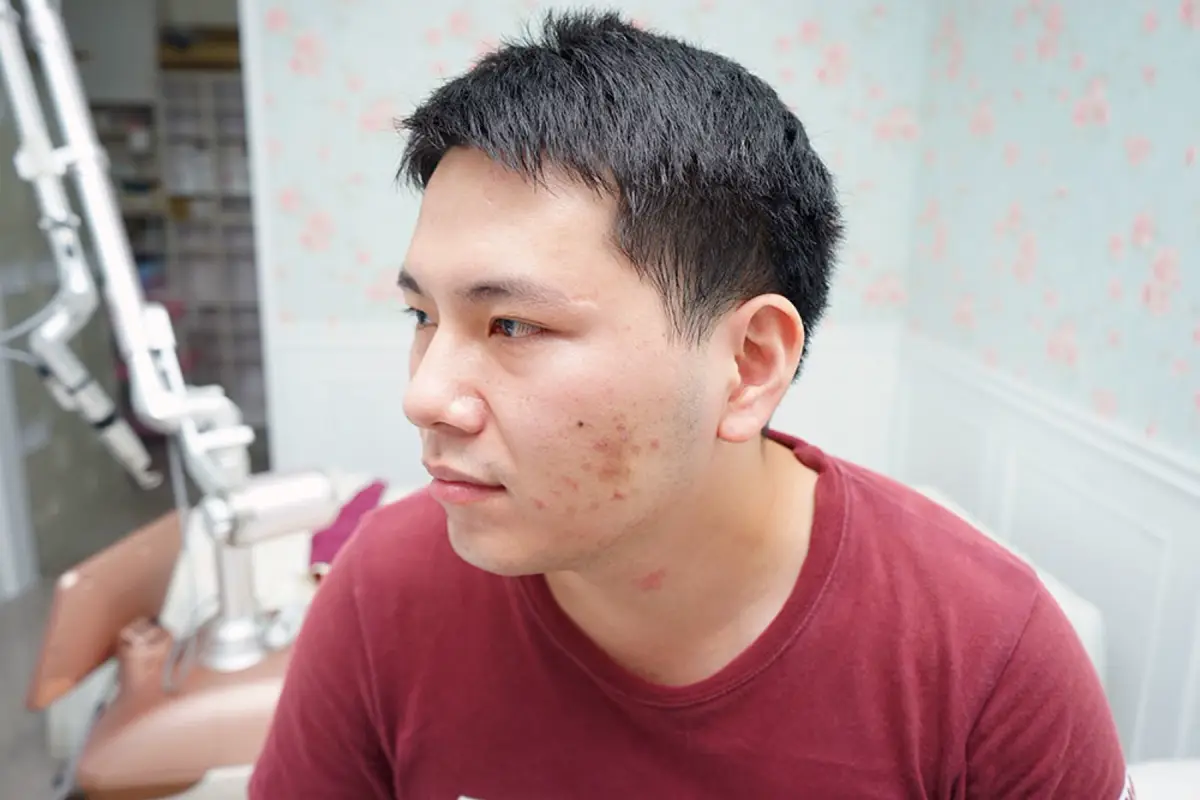 嘉義劉怡慧皮膚科診所 雷射痘疤治療