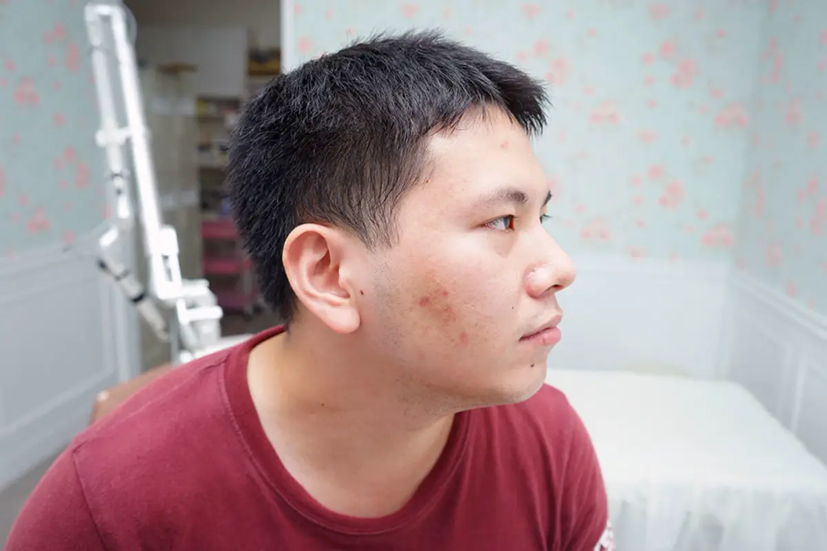 嘉義劉怡慧皮膚科診所 雷射痘疤治療
