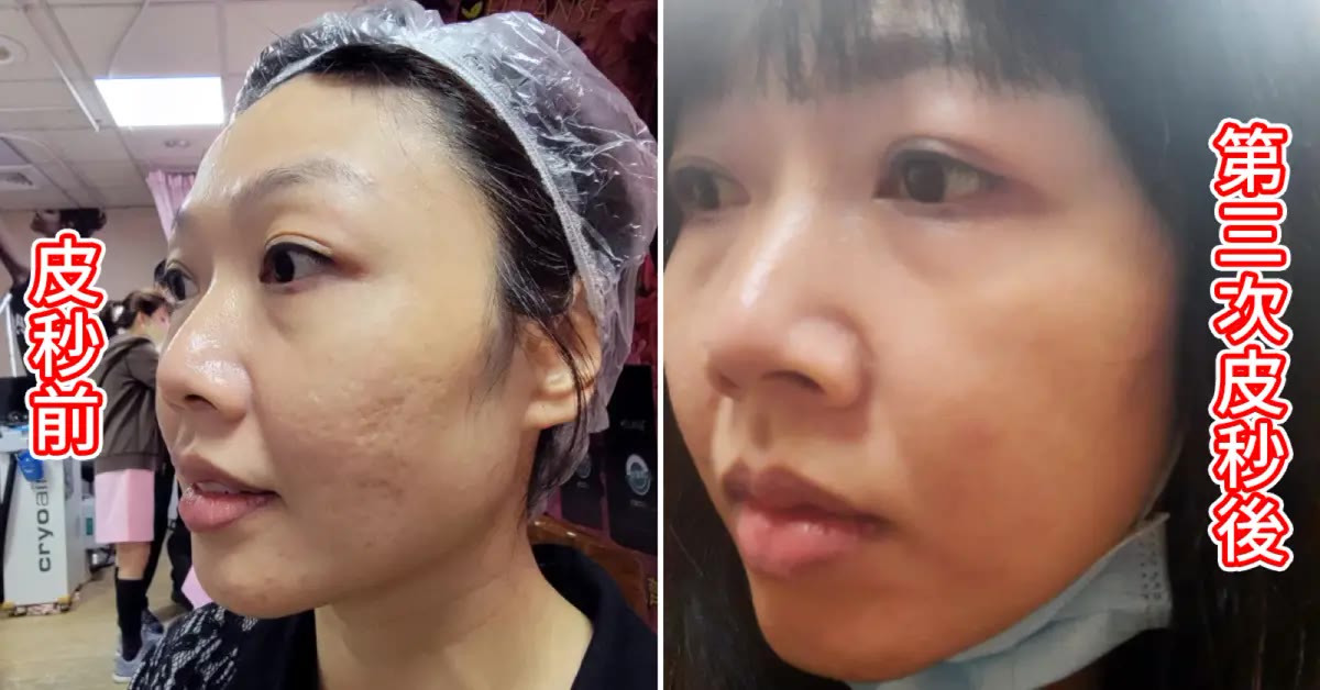 嘉義皮秒雷射｜郭健軍皮膚科診所，醫生親打改善痘疤毛孔